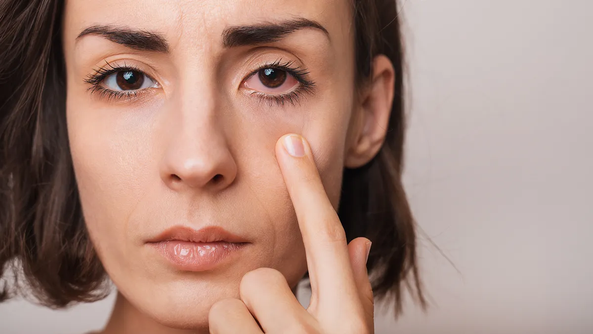 a woman with an irritated, red eye